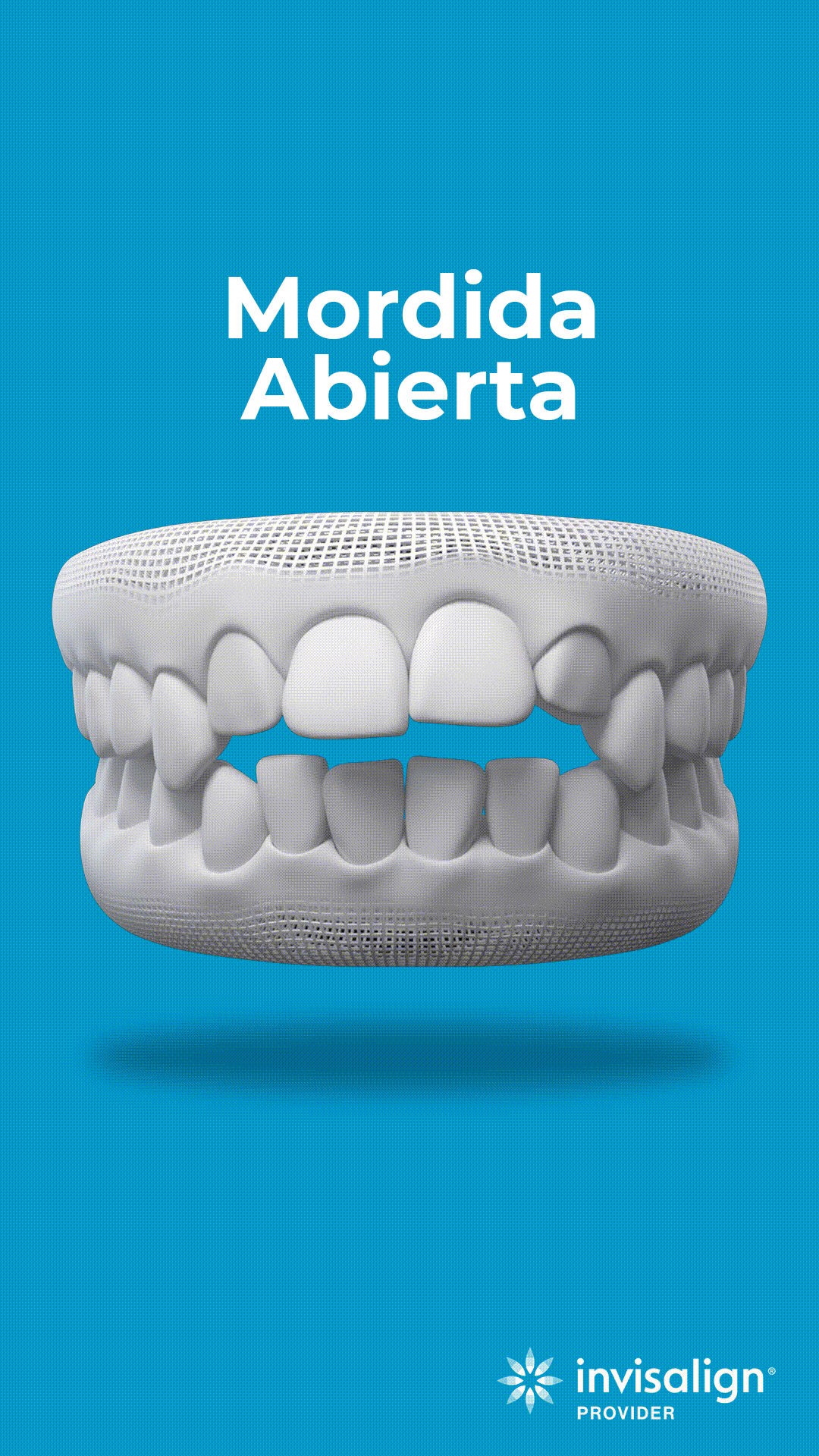 mordida-abierta